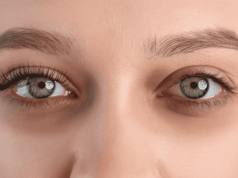 Tratamento para Olheiras na Magrass: saiba como funciona e quais os resultados