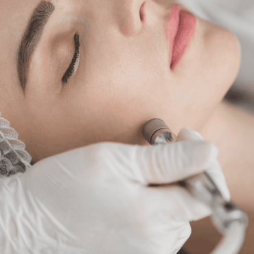 Peeling de Diamante em Camaquã