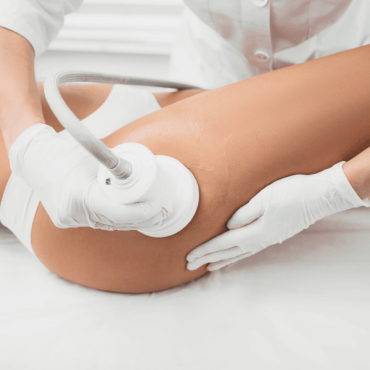 Tratamento para Celulite em Camaquã