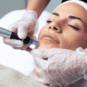 Microagulhamento em Camaquã