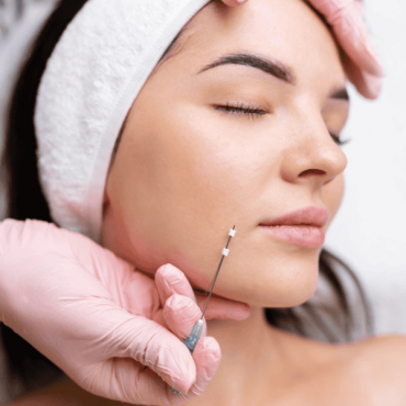 Fios de PDO em Camaquã