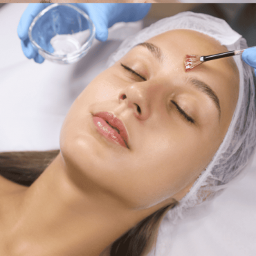 Peelings Químicos em Camaquã