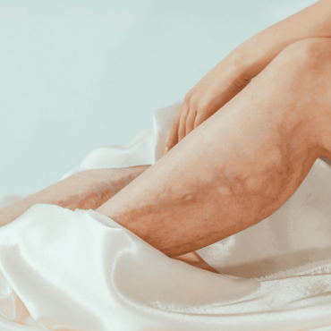 Tratamento para Lipedema em Camaquã