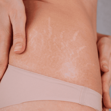 Tratamento para Estrias em Camaquã