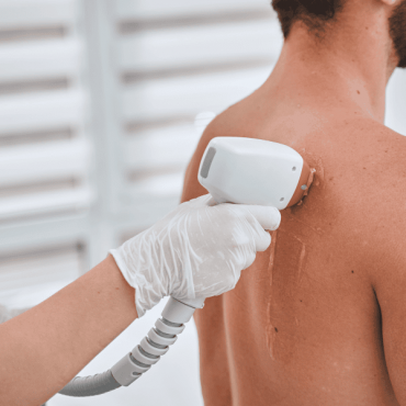 Depilação a Laser Masculina em Camaquã