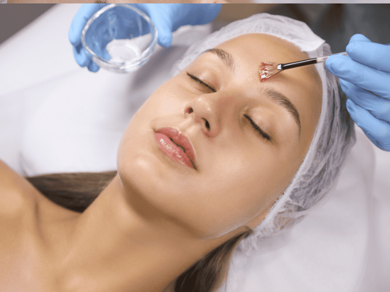 Peelings Químicos