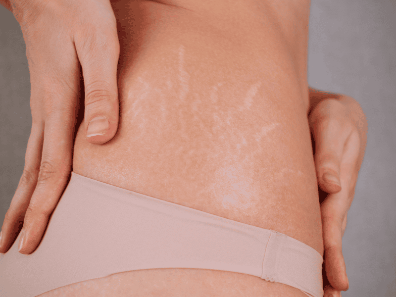 Tratamento para Estrias