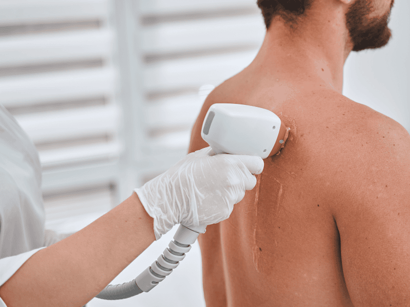 Depilação a Laser Masculina